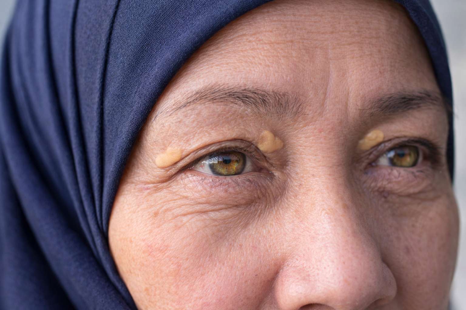 Biji Kolesterol di Kelopak Mata: Punca, Rawatan & Kos Rawatan di Setapak